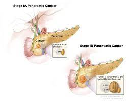 Understanding and Managing Pancreatic Cancer